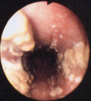 yeast in throat